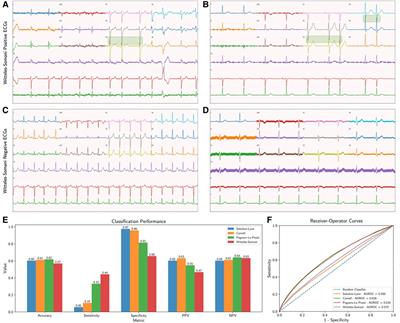 Development and validation of a rapid visual technique for left ventricular hypertrophy detection from the electrocardiogram